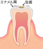 光が丘歯科 虫歯の進行と治療 C1（エナメル質の虫歯）画像
