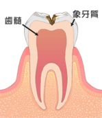 光が丘歯科 虫歯の進行と治療 C2（象牙質の虫歯）画像