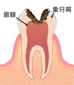 光が丘歯科 C3（神経に達した虫歯）画像