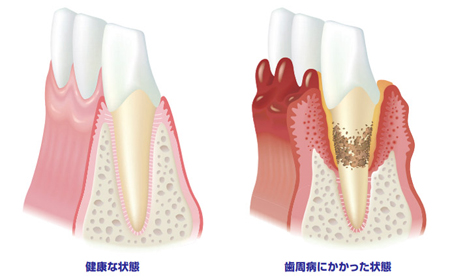 歯周病ってなに？