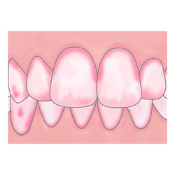 光が丘歯科 プラークの染め出し