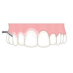 光が丘歯科 フッ素塗布