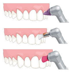光が丘歯科 フッ素塗布